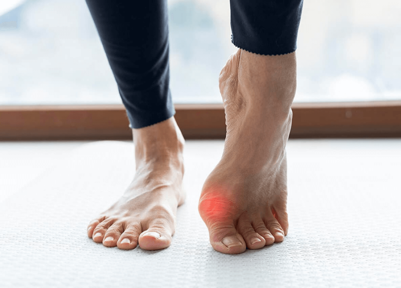 Halluks Valgus Bunyon